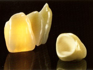ästhetischer metallfreier Zahnersatz mit Zirkonoxid