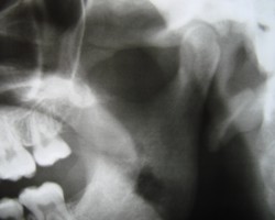 Röntgenbild Kiefergelenk