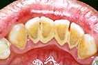 Zähne mit Zahnstein